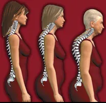 Osteoporoz